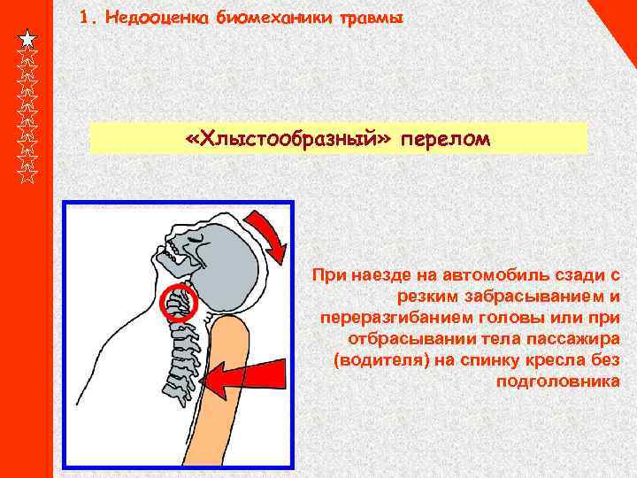 1. Недооценка биомеханики травмы «Хлыстообразный» перелом При наезде на автомобиль сзади с резким забрасыванием