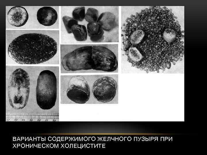 ВАРИАНТЫ СОДЕРЖИМОГО ЖЕЛЧНОГО ПУЗЫРЯ ПРИ ХРОНИЧЕСКОМ ХОЛЕЦИСТИТЕ 