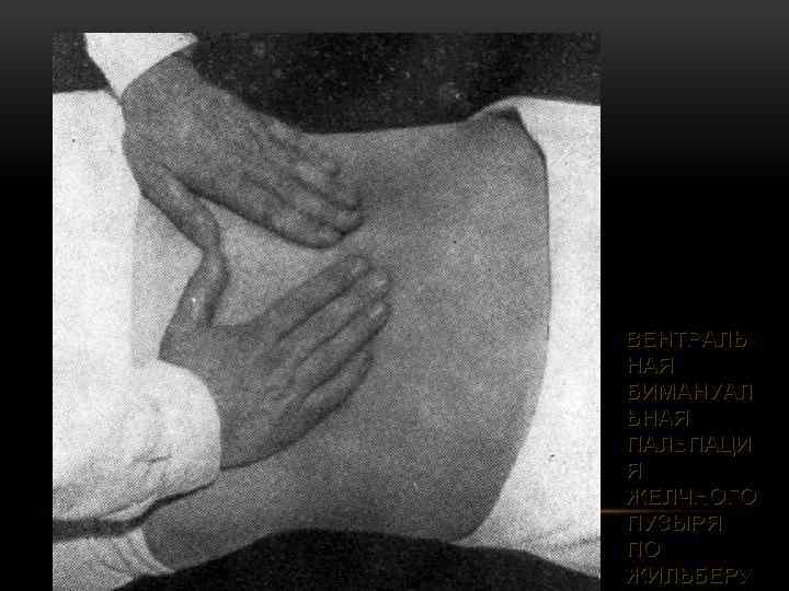 ВЕНТРАЛЬ НАЯ БИМАНУАЛ ЬНАЯ ПАЛЬПАЦИ Я ЖЕЛЧНОГО ПУЗЫРЯ ПО ЖИЛЬБЕРУ 