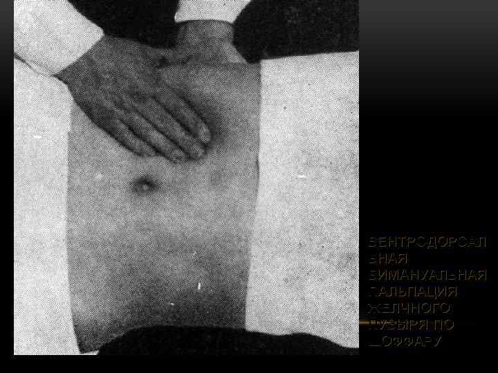ВЕНТРОДОРСАЛ ЬНАЯ БИМАНУАЛЬНАЯ ПАЛЬПАЦИЯ ЖЕЛЧНОГО ПУЗЫРЯ ПО ШОФФАРУ 