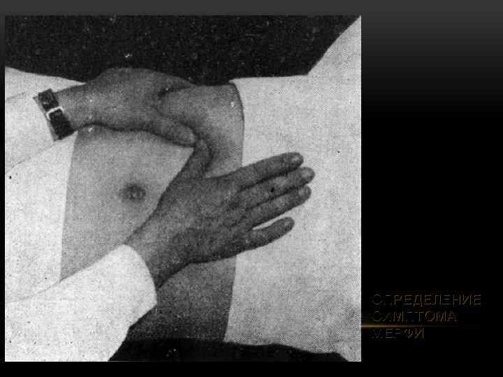 ОПРЕДЕЛЕНИЕ СИМПТОМА МЕРФИ 