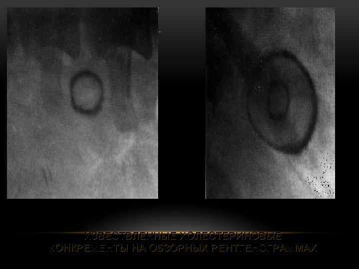 ИЗВЕСТВЛЕННЫЕ ХОЛЕСТЕРИНОВЫЕ КОНКРЕМЕНТЫ НА ОБЗОРНЫХ РЕНТГЕНОГРАММАХ 