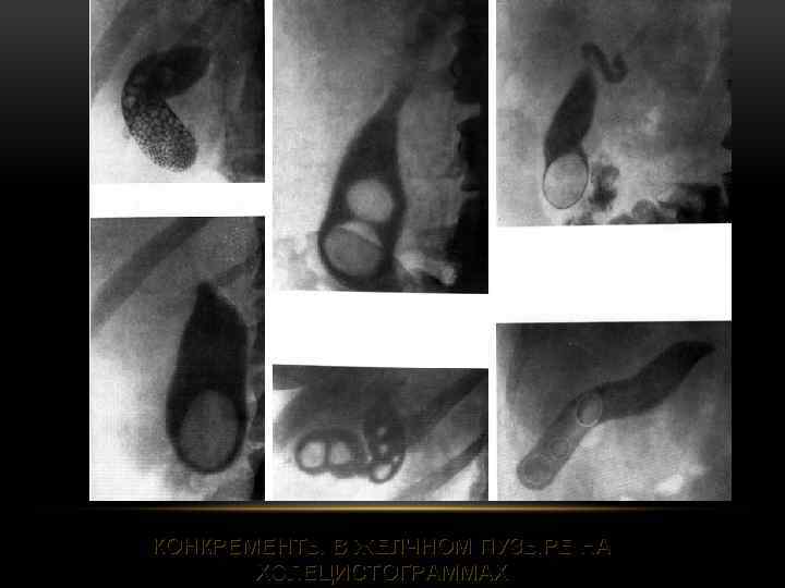КОНКРЕМЕНТЫ В ЖЕЛЧНОМ ПУЗЫРЕ НА ХОЛЕЦИСТОГРАММАХ 