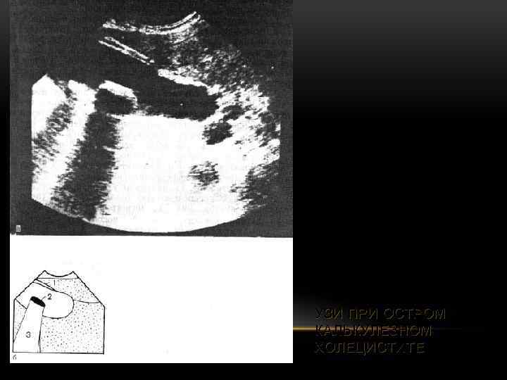 УЗИ ПРИ ОСТРОМ КАЛЬКУЛЕЗНОМ ХОЛЕЦИСТИТЕ 