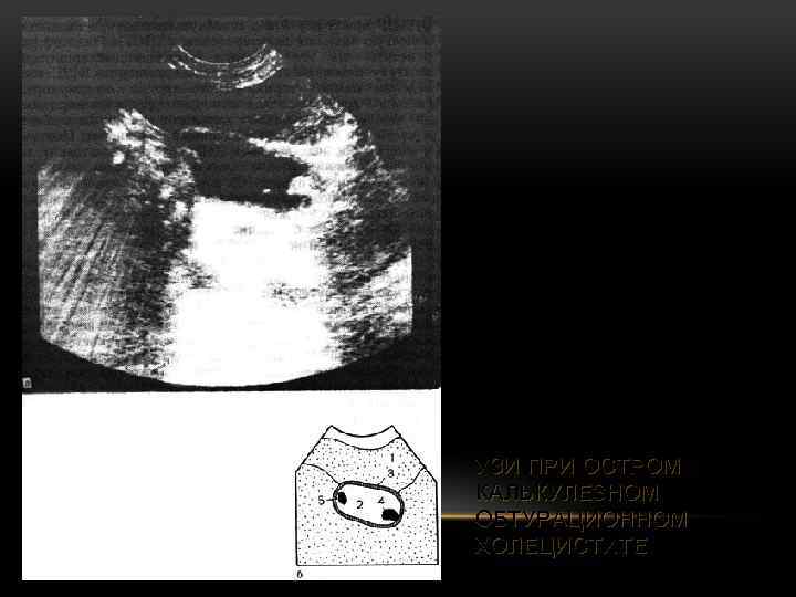 УЗИ ПРИ ОСТРОМ КАЛЬКУЛЕЗНОМ ОБТУРАЦИОННОМ ХОЛЕЦИСТИТЕ 