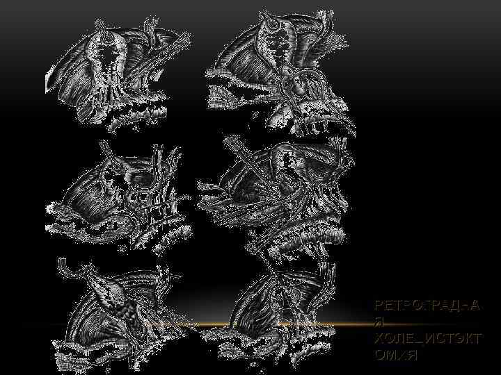 РЕТРОГРАДНА Я ХОЛЕЦИСТЭКТ ОМИЯ 