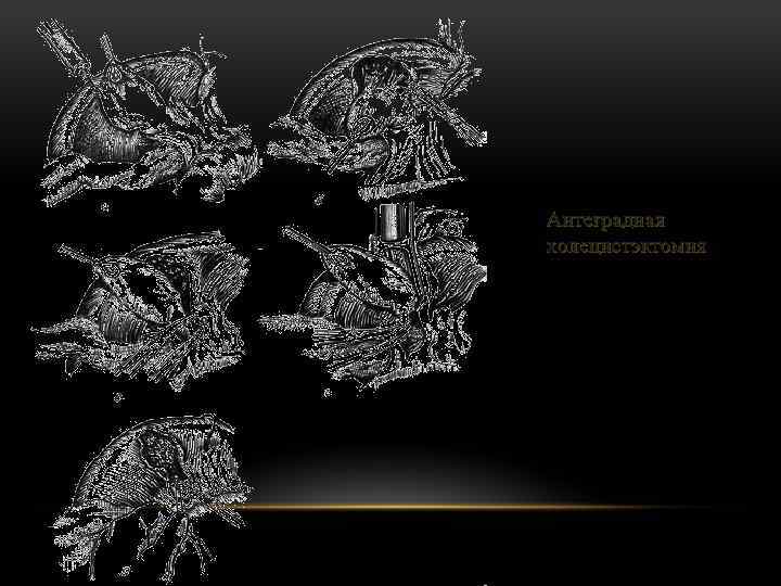 Антеградная холецистэктомия 
