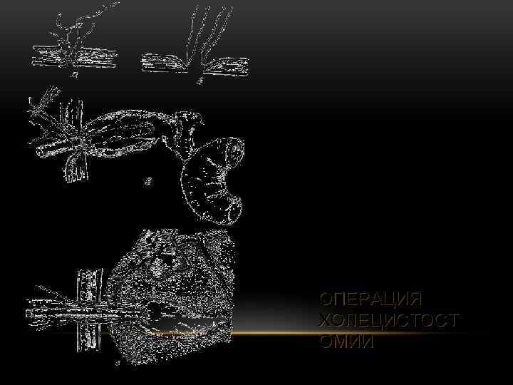 ОПЕРАЦИЯ ХОЛЕЦИСТОСТ ОМИИ 