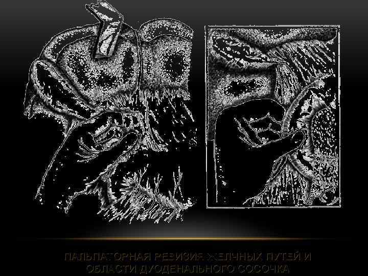 ПАЛЬПАТОРНАЯ РЕВИЗИЯ ЖЕЛЧНЫХ ПУТЕЙ И ОБЛАСТИ ДУОДЕНАЛЬНОГО СОСОЧКА 