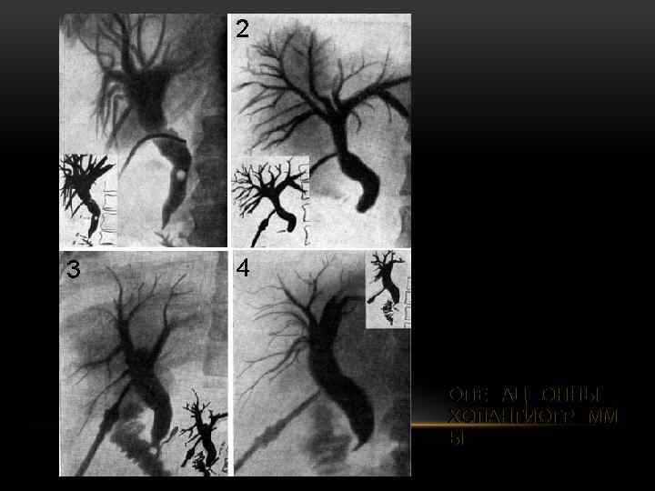 ОПЕРАЦИОННЫЕ ХОЛАНГИОГРАММ Ы 