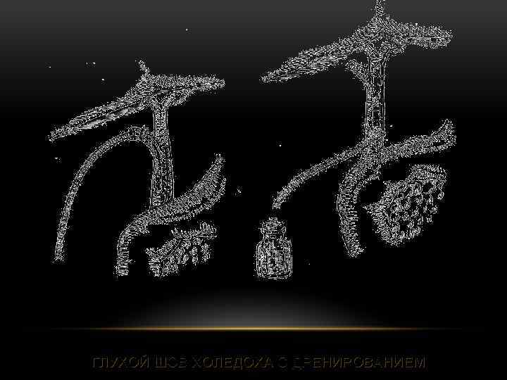 ГЛУХОЙ ШОВ ХОЛЕДОХА С ДРЕНИРОВАНИЕМ 