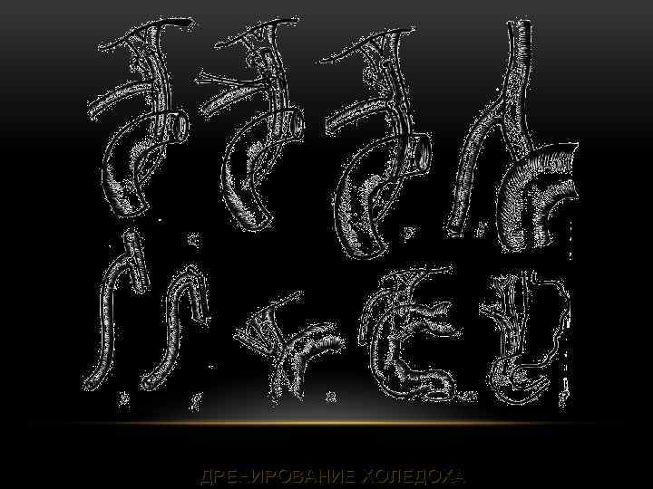 ДРЕНИРОВАНИЕ ХОЛЕДОХА 