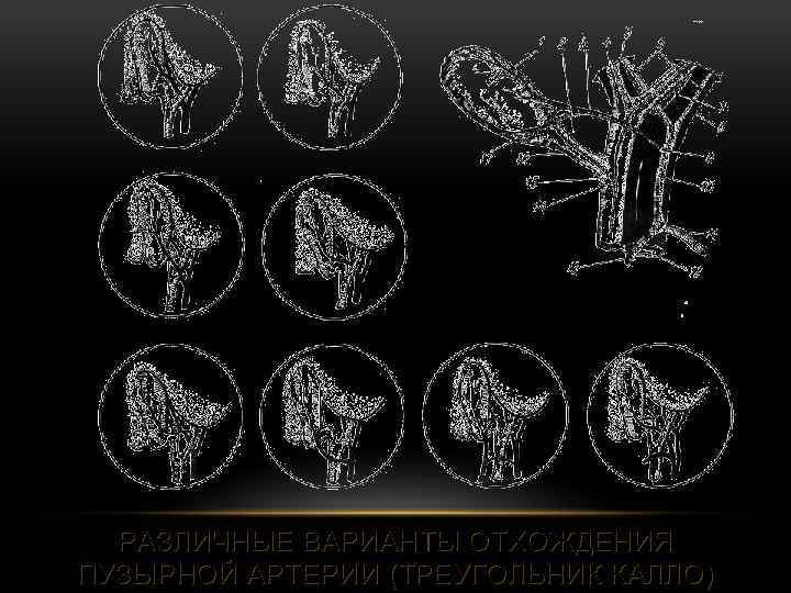 РАЗЛИЧНЫЕ ВАРИАНТЫ ОТХОЖДЕНИЯ ПУЗЫРНОЙ АРТЕРИИ (ТРЕУГОЛЬНИК КАЛЛО) 