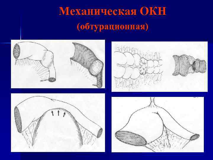 Механическая ОКН (обтурационная) 