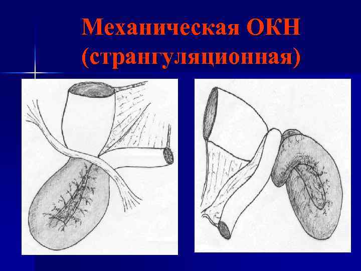 Механическая ОКН (странгуляционная) 