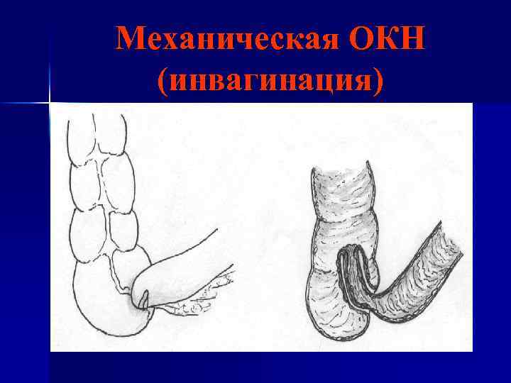 Механическая ОКН (инвагинация) 