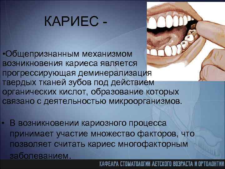 КАРИЕС • Общепризнанным механизмом возникновения кариеса является прогрессирующая деминерализация твердых тканей зубов под действием