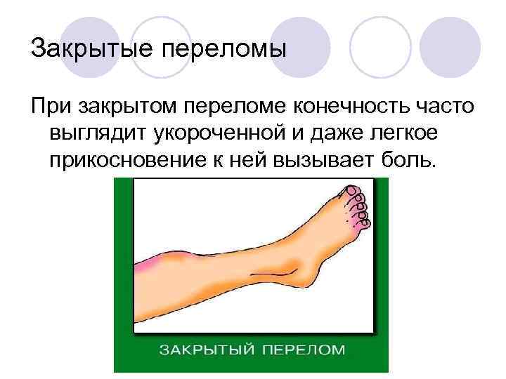 Закрытые переломы При закрытом переломе конечность часто выглядит укороченной и даже легкое прикосновение к