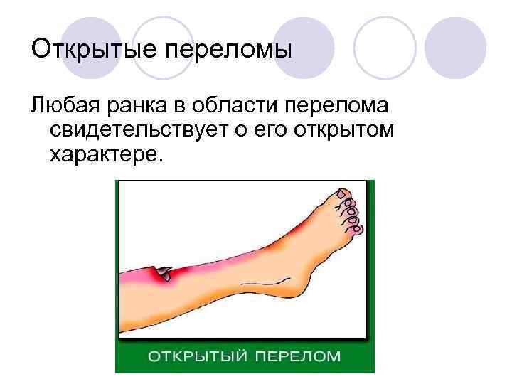 Открытые переломы Любая ранка в области перелома свидетельствует о его открытом характере. 
