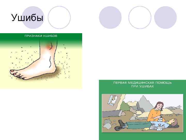 Ушибы 