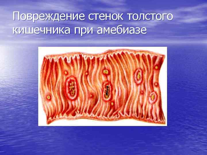 Повреждение стенок толстого кишечника при амебиазе 