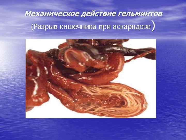 Механическое действие гельминтов (Разрыв кишечника при аскаридозе) 