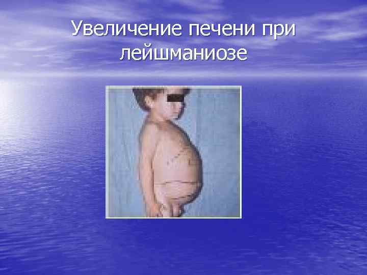 Увеличение печени при лейшманиозе 
