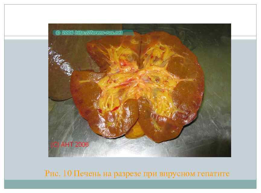 Рис. 10 Печень на разрезе при вирусном гепатите 