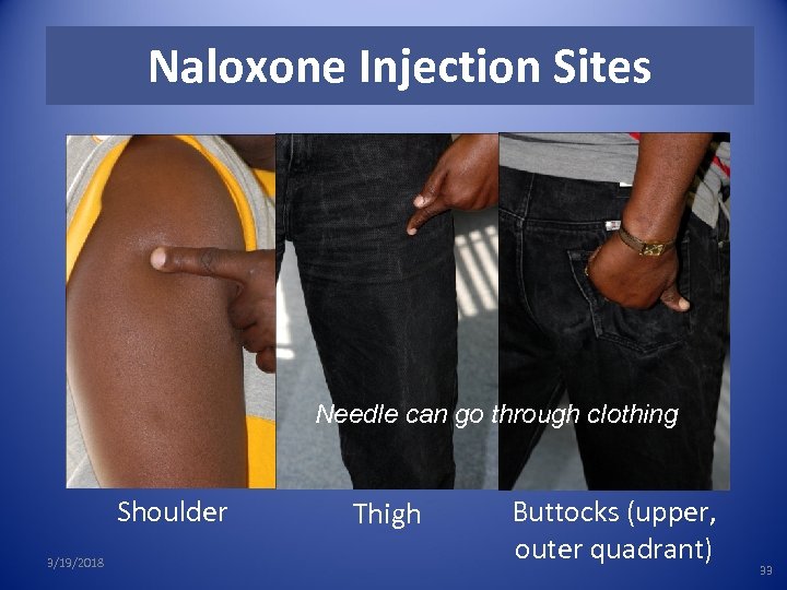 Naloxone Injection Sites Needle can go through clothing Shoulder 3/19/2018 Thigh Buttocks (upper, outer