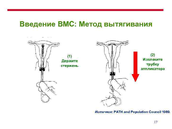 Введение ВМС: Метод вытягивания (1) Держите стержень (2) Извлеките трубку аппликатора Источник: PATH and