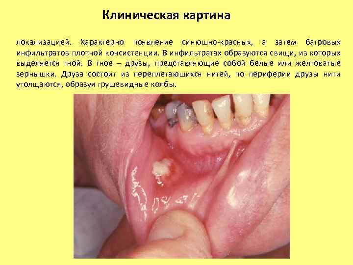 Клиническая картина локализацией. Характерно появление синюшно-красных, а затем багровых инфильтратов плотной консистенции. В инфильтратах