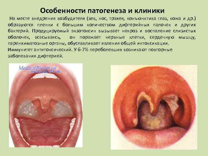 Особенности патогенеза и клиники На месте внедрения возбудителя (зев, нос, трахея, конъюнктива глаз, кожа