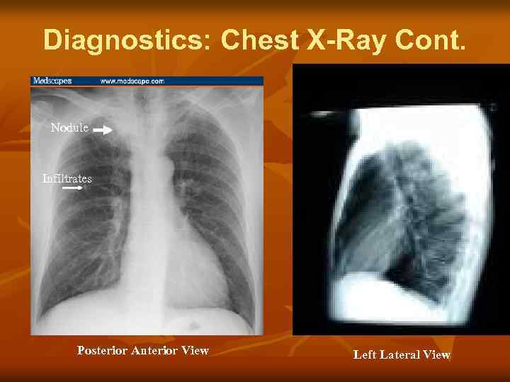 Diagnostics: Chest X-Ray Cont. Nodule Infiltrates Posterior Anterior View Left Lateral View 