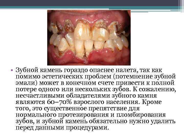  • Зубной камень гораздо опаснее налета, так как помимо эстетических проблем (потемнение зубной