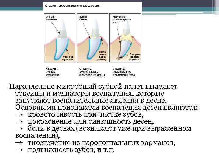 Параллельно микробный зубной налет выделяет токсины и медиаторы воспаления, которые запускают воспалительные явления в