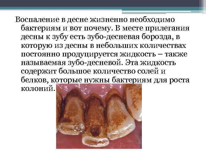 Воспаление в десне жизненно необходимо бактериям и вот почему. В месте прилегания десны к