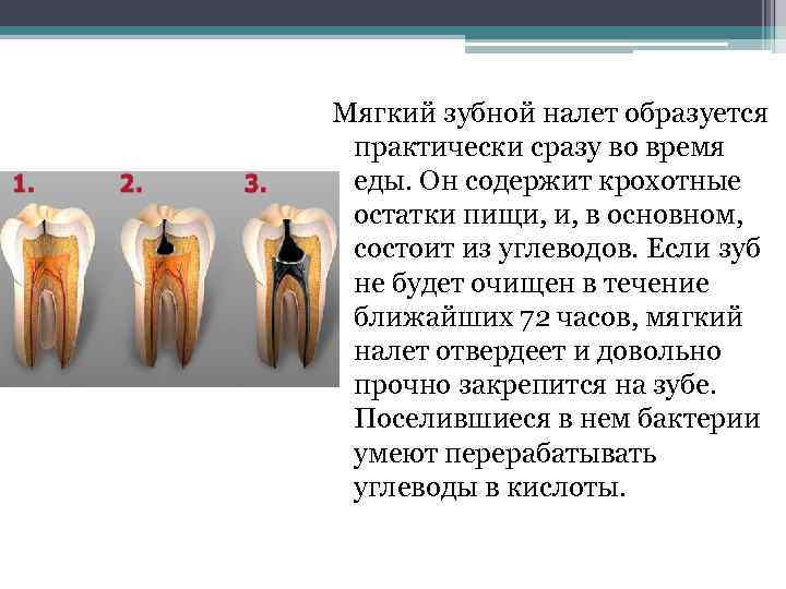 Мягкий зубной налет образуется практически сразу во время еды. Он содержит крохотные остатки пищи,