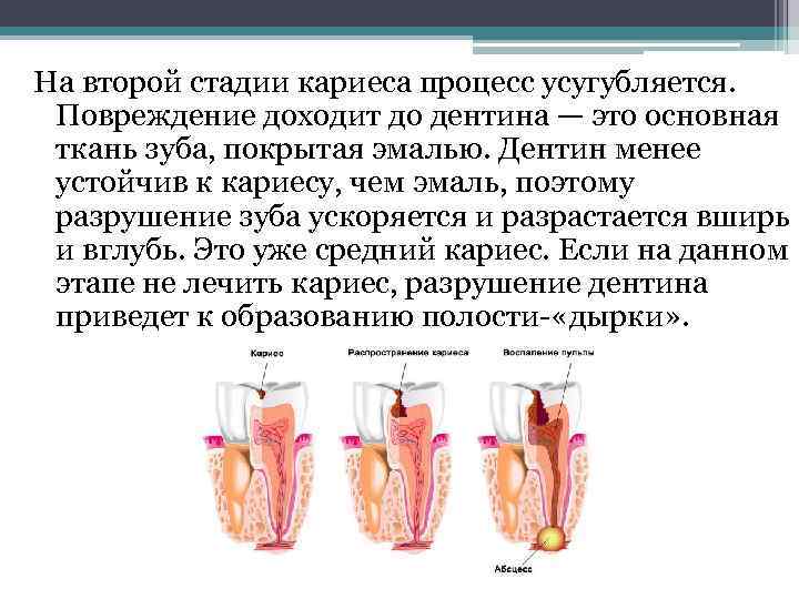 Стадии кариеса. Кариес стадии процесса. Образование кариеса начинается с повреждения. Степень кариозного процесса.