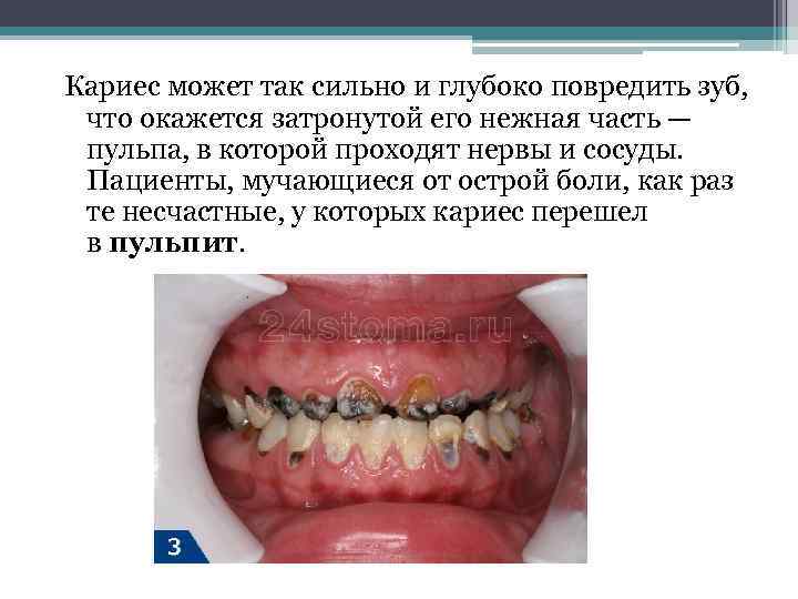 Кариес может так сильно и глубоко повредить зуб, что окажется затронутой его нежная часть