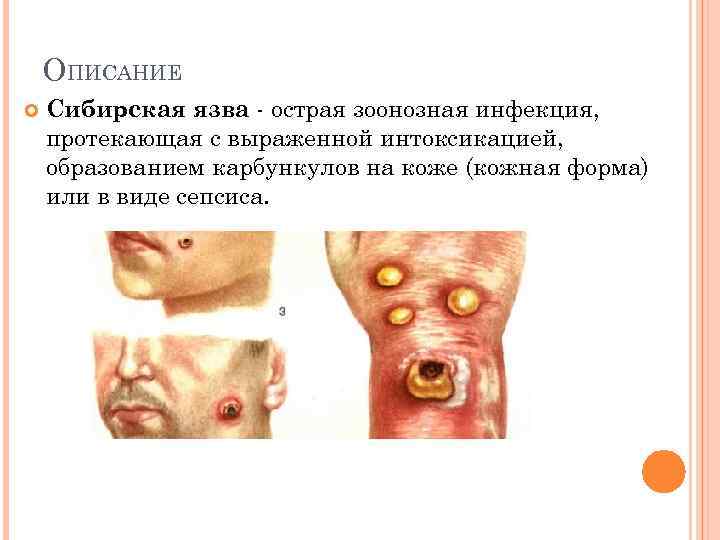 ОПИСАНИЕ Сибирская язва - острая зоонозная инфекция, протекающая с выраженной интоксикацией, образованием карбункулов на