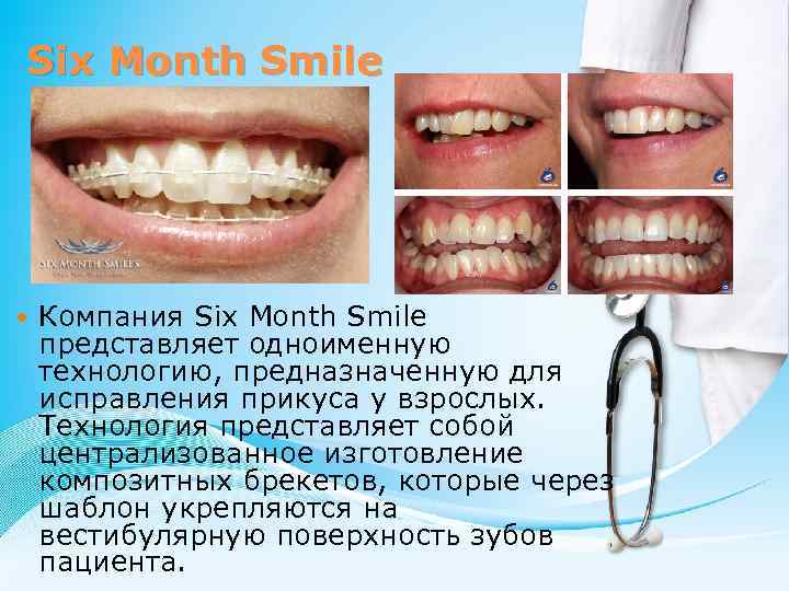 Six Month Smile Компания Six Month Smile представляет одноименную технологию, предназначенную для исправления прикуса