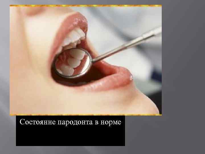 Состояние пародонта в норме 