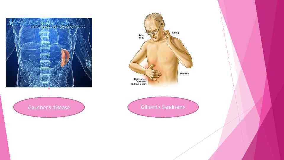 Gaucher's disease Gilbert's Syndrome 