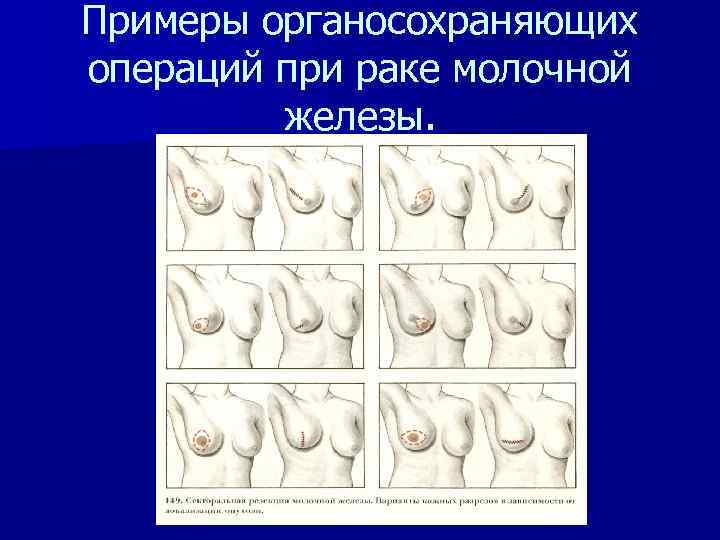 Примеры органосохраняющих операций при раке молочной железы. 