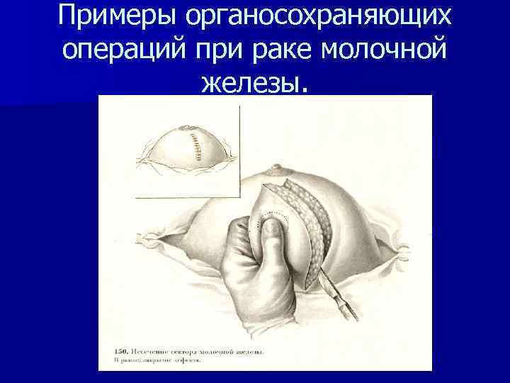 Примеры органосохраняющих операций при раке молочной железы. 