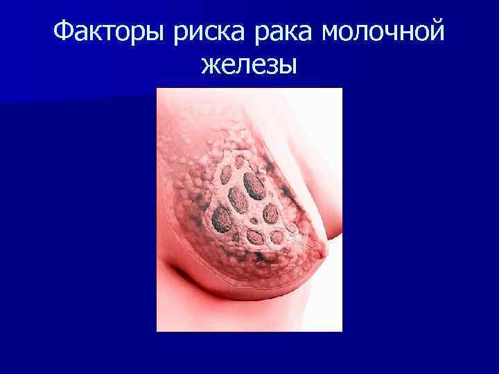 Факторы риска рака молочной железы 