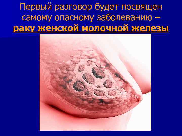Первый разговор будет посвящен самому опасному заболеванию – раку женской молочной железы 