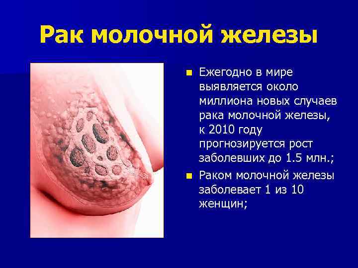 Рак молочной железы Ежегодно в мире выявляется около миллиона новых случаев рака молочной железы,