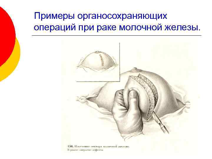 Примеры органосохраняющих операций при раке молочной железы. 