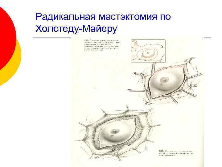 Радикальная мастэктомия по Холстеду-Майеру 